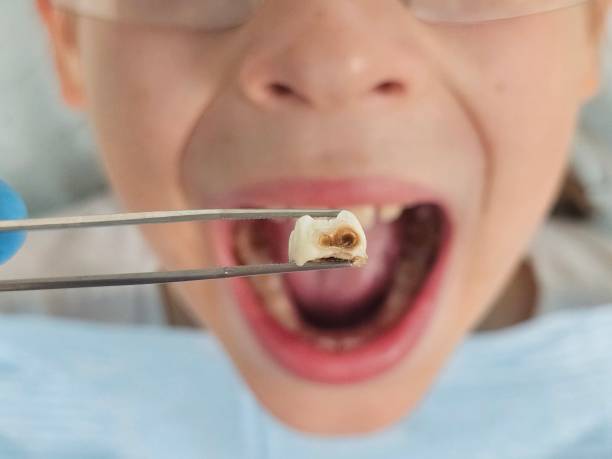 Best Emergency Dental Care for Broken or Chipped Teeth in Merton, WI